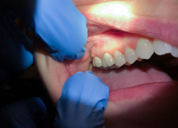 Best Emergency Treatment for Toothache in Watergate, FL