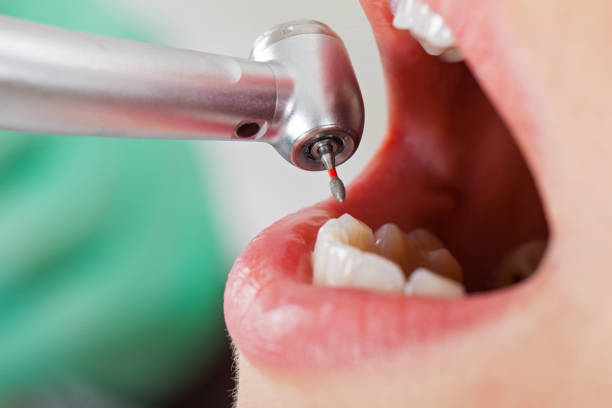 Best Emergency Wisdom Teeth Removal in Watergate, FL
